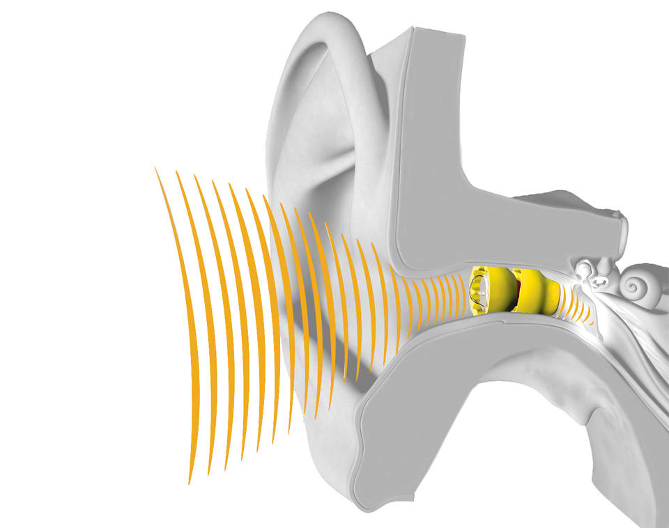Lyric Hearing Aid Review ZipHearing