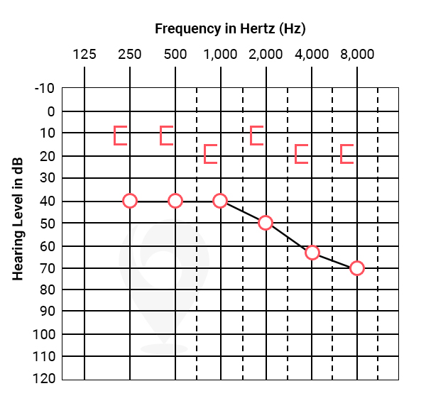 Conductive hearing loss audiogram