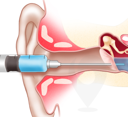 steroid injection for sudden hearing loss