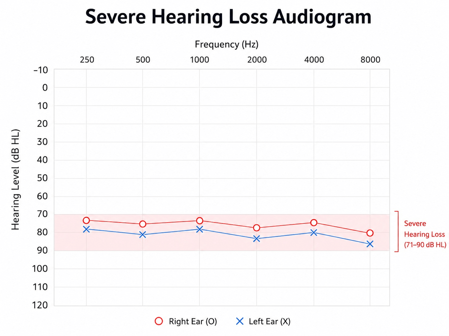 Audiogram (hearing test results), showing a hypothetical user with a severe hearing loss